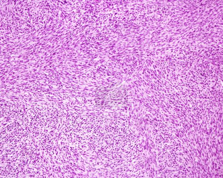 Light microscope micrograph of a fibrosarcoma, a malignant mesenchymal tumour derived from fibrous connective tissue. The tumour cells are closely packed and arranged in short fascicles which split and merge. There are mitosis, a low grade of nuclear