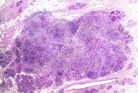 Carcinome du canal mammaire. Micrographie photonique à très faible grossissement montrant des cordes et des nids irréguliers de cellules cancéreuses canalaires malignes envahissant le stroma mammaire.