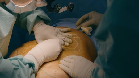 Téléchargez les photos : Deux hommes médecins chirurgien médecin mains coupées scalpel faire incision sur l'abdomen du patient ventre chirurgie plastique césarienne chirurgie médecine en clinique hospitalière soins de santé d'urgence - en image libre de droit