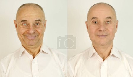 ältere kaukasische männliche Gesicht mit Schwellungen unter Augen und Falten vor und nach der Behandlung, zwei Schüsse kosmetische Eingriffe, reifer Mann, Senior 60 Jahre alt, altersbedingte Hautveränderungen, plastische Chirurgie
