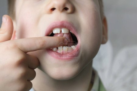 Photo for Small patient, child, boy 7 years opened mouth touches tip tongue, performs therapy exercises, speech disorders, correction, frenum of tongue, develop skills like comprehension, communication problems - Royalty Free Image