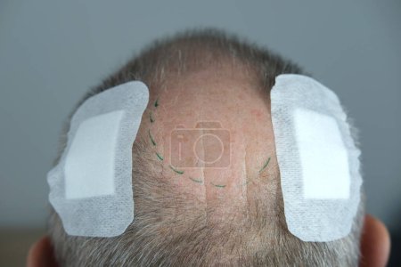 Nahaufnahme Trichologe behandelt Patienten, glatzköpfige reife Mann mit Alopezie in Haarwuchsklinik, Anti-Aging-Behandlungen für Glatzköpfe. Konzept der Haartransplantation für Männer, selektiver Fokus