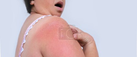 Photo for Close-up of part of female shoulder with sunburnt skin, adult female patient, woman suffers from pain, redness, scarring of skin, concept of medical care, health care, human tissue regeneration - Royalty Free Image