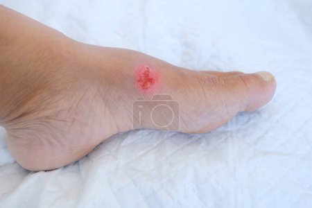 Photo for Closeup of weeping wound, thermal burn, trophic ulcer on female leg, treatment wound surface of skin and deep tissues, concept of eliminating inflammatory process, sanitation pathogenic microflora - Royalty Free Image