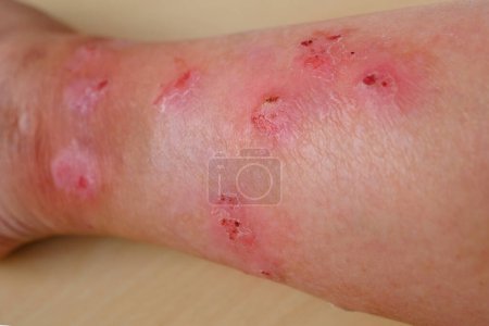 Photo for Closeup weeping wounds, venous ulcers on female leg, diabetes mellitus, varicose veins, healing ulcers by destroying growth factors, eliminating inflammatory process, sanitation pathogenic microflora - Royalty Free Image