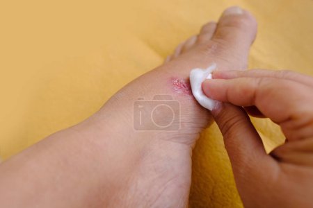 Photo for Closeup of weeping wound, thermal burn, trophic ulcer on female leg, treatment wound surface of skin and deep tissues, concept of eliminating inflammatory process, sanitation pathogenic microflora - Royalty Free Image