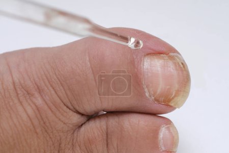 dermatologist, dermatovenereologist, podologist treats damaged rude nail on big toe of female foot, exfoliation, nail fungus, treatment Nail onycholysis, Paramedical, Medical pedicure, aging problems