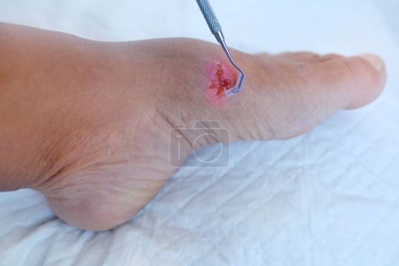 Photo for Doctor treats weeping wound, trophic ulcer on female leg, wound exudate prevents healing ulcers by destroying growth factors, concept eliminating inflammatory process, sanitation pathogenic microflora - Royalty Free Image