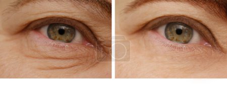 primer plano parte de la cara mujer madura 55 años, ojo humano, párpado superior, arrugas profundas alrededor de los ojos, antes y después de cambios en la piel, procedimientos cosméticos anti-envejecimiento, control de la visión, corrección de la hipermetropía