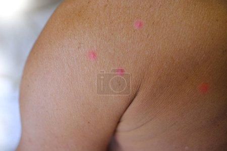 Photo for Close-up injured male back, shoulder, skin bitten by mosquitoes, itchy rashes on skin, damaged reddened skin, insect bite remedies, scratching sensation, skin discomfort, bite marks - Royalty Free Image
