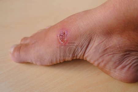 Photo for Closeup of weeping wound, trophic ulcer on female leg, wound exudate prevents healing ulcers by destroying growth factors, concept of eliminating inflammatory process, sanitation pathogenic microflora - Royalty Free Image