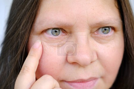 primer plano de la mujer madura 50 años de edad mira cuidadosamente hinchazón bajo los ojos, examina las arrugas en la cara, pliegues de la piel, cambios en la piel relacionados con la edad, cosmetología inyección estética, procedimientos anti-envejecimiento del cuidado