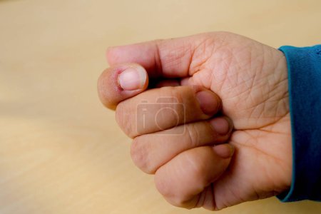 primer plano parte de la mano femenina, dedo inflamado, daño al agujero de las uñas, desgarro resultante, inflamación de las rebabas, supuración, uñas mordedoras, lesiones, manicura descuidada