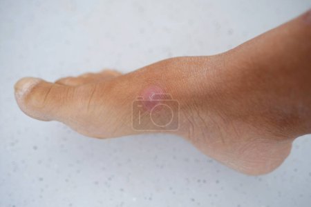 Foto de Primer plano parte del pie femenino, cicatriz rosada redonda de la herida curada, concepto de lesión industrial o doméstica, cicatrización de los tejidos musculares y de la piel, cicatrices queloides - Imagen libre de derechos