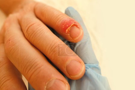Arzt behandelt verletzte Finger, Nagelschäden durch Aufprall, Kompression, Riss, einen Teil der Verletzung des männlichen Daumens Nahaufnahme, Prellungen, industrielle oder häusliche Verletzungen, Rötungen, Eiterbildung