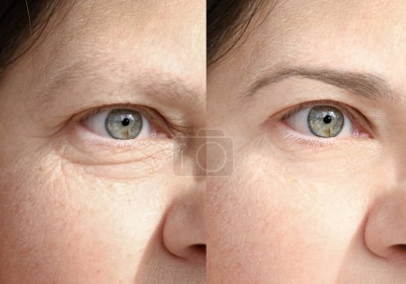 Photo for Close up part face mature woman 55 years old, human eye, lower, upper eyelid, deep facial wrinkles around eyes before and after treatment, correction surgery, antiaging procedures - Royalty Free Image