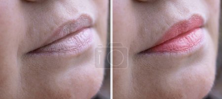 Téléchargez les photos : Gros plan partie visage, lèvres femme mature 55 ans, lèvres gercées avant et après la procédure, changements de peau, procédures cosmétiques anti-âge - en image libre de droit