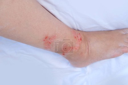 Nahaufnahme verletzte weibliche Gliedmaßen mit geschädigter geröteter Haut, Kratzer, Wunde am schmerzhaften weiblichen Bein, medizinisches Konzept, chronische Erkrankung, dermatologische Störung, Hautproblem, betroffene Stelle