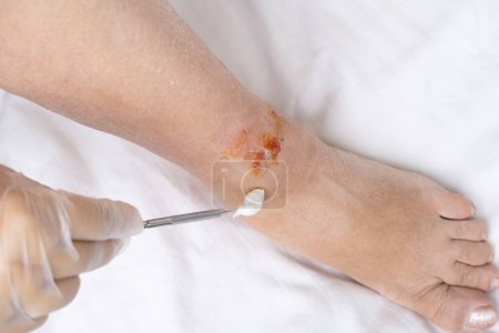 doctor treats healing wound from severe burn on leg adult female patient, redness, scarring of skin, medical care, human tissue regeneration