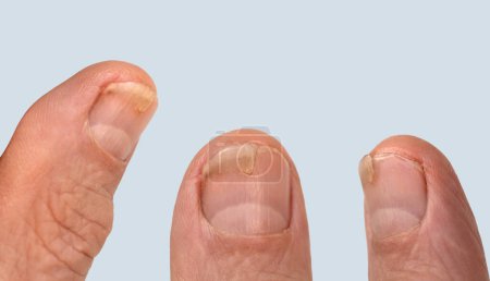 dedo lesionado, daños en las uñas por impacto, compresión, desgarro, parte de la lesión del dedo masculino de cerca, moretones, lesiones industriales o domésticas, supuración