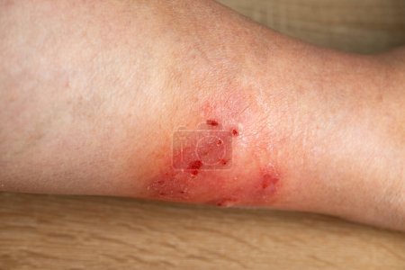 itchy skin on leg, inflammation and Medical Allergies, disease on body female patient, Dermatology Skin Issues, skin problems, health care, human tissue regeneration