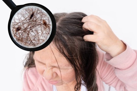 Photo for Woman scratching head, close-up hair lice, feeling itchy and possibly having lice, showing effects of infestation, Medical conditions, Pediculosis, itching and irritation - Royalty Free Image