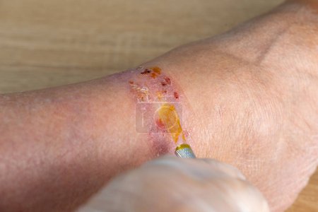 doctor treats large healing wound from on lower leg with scars of adult patient, inflammation and Medical Allergies, scarring skin, scald on female limb