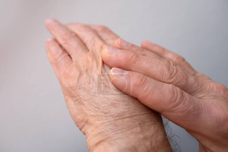 Man examining inflamed area on hand, self-massaging for pain relief, Skin health and care, disease prevention and maintenance health, performing self-massage, treatment of rheumatism, skin conditions