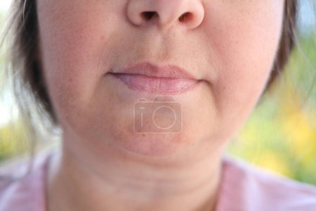 close up part face mature woman 55 years old, lower half of face, deep wrinkles around mouth, sagging cheeks, sagging cheeks, aesthetic injection cosmetology, correction surgery, antiaging procedures