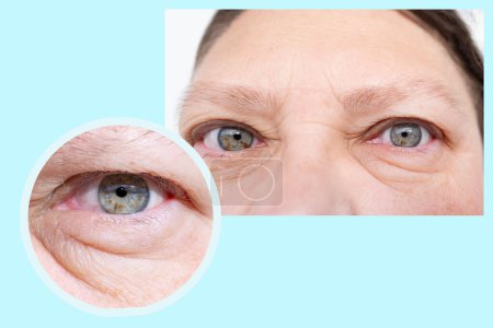 Nahaufnahme Gesicht Frau mittleren Alters in zwei Versionen, Schwellungen unter dem unteren Augenlid, Falten auf der Haut, Konzept Allergien, Nierenerkrankungen, Anti-Aging-Verfahren