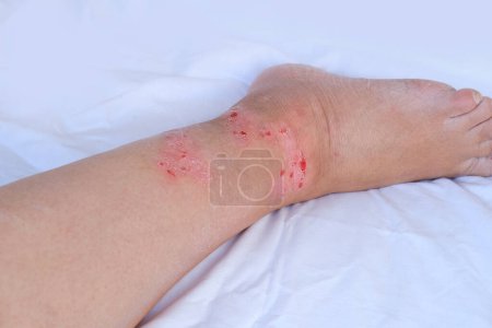 Nahaufnahme verletzte weibliche Gliedmaßen mit geschädigter geröteter Haut, Kratzer, Wunde am schmerzhaften weiblichen Bein, medizinisches Konzept, chronische Erkrankung, dermatologische Störung, Hautproblem, betroffene Stelle