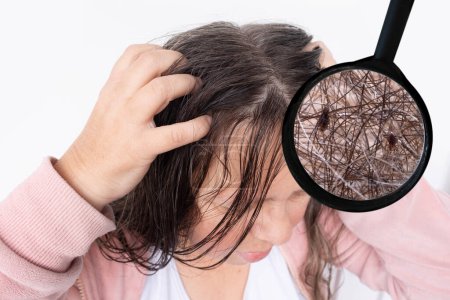 Frau kratzt Kopf, Nahaufnahme Haarläuse, juckt und hat möglicherweise Läuse, zeigt Auswirkungen von Befall, Erkrankungen, Pediculosis, Juckreiz und Reizungen