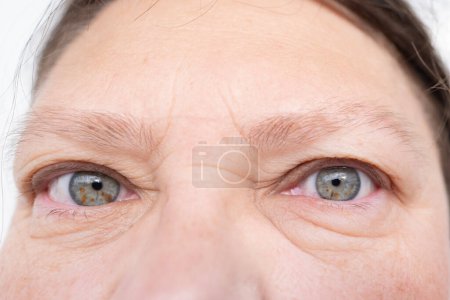 weibliche Augen reife Frau, Nahaufnahme Falten, unter den Augen Taschen, Schwellungen auf dem unteren Augenlid, Allergien, Nierenerkrankungen, Erkrankungen
