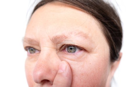 female eye mature woman, close-up wrinkles, under eye bags, swelling on lower eyelid, allergies, kidney disease, medical conditions
