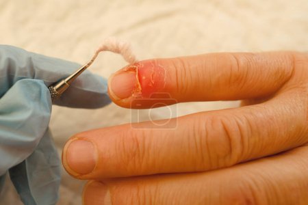 Medizinische Behandlung von Fingerverletzungen, Arzt behandelt verletzte Finger, Nagelschäden durch Aufprall, Kompression, Riss, Teil der männlichen Daumenverletzung Nahaufnahme