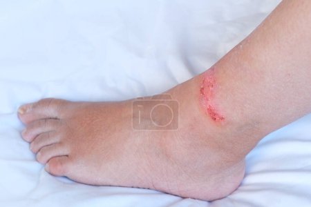 Nahaufnahme verletzte weibliche Gliedmaßen mit geschädigter geröteter Haut, Kratzer, Wunde am schmerzhaften weiblichen Bein,