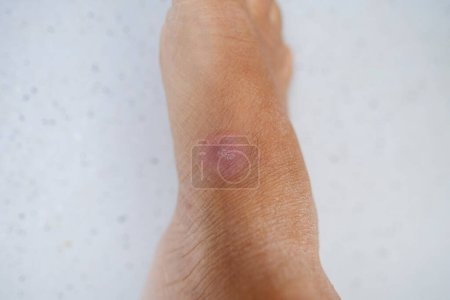 Foto de Primer plano parte del pie femenino, cicatriz rosada redonda de la herida curada, concepto de lesión industrial o doméstica, cicatrización de los tejidos musculares y de la piel, cicatrices queloides - Imagen libre de derechos