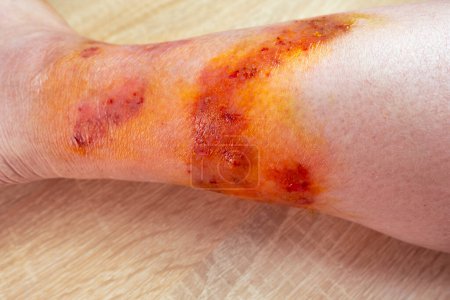 large healing wound from on lower leg with scars of adult female patient, redness, scarring skin, concept of medical care, treatment and medicinal disinfection damaged skin, human tissue regeneration