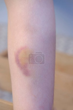 Photo for Bruise on child's leg, wound healing process in child, Pediatric medicine, childhood accidents, domestic violence, safety, minor trauma, skin discoloration - Royalty Free Image