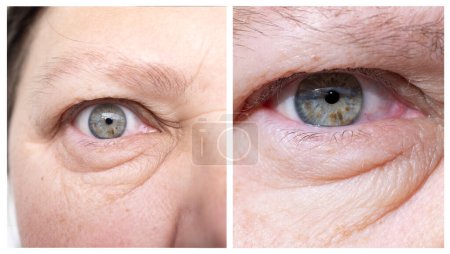 close-up part face middle-aged woman in two versions, puffiness under lower eyelid, wrinkles on skin, concept allergies, kidney disease, anti-aging procedures