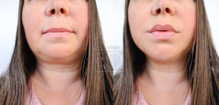 Nahaufnahme des weiblichen Gesichts einer Frau im Alter von 40-50 Jahren mit Altersfalten, Gesichtsfalten vor und nach der Behandlung, Konzept der Kosmetik, Lippenvergrößerung, Korrekturchirurgie, kosmetische Eingriffe