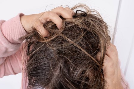 Frau kratzt braune Haare, juckt und hat möglicherweise Läuse, zeigt Auswirkungen von Befall, Körperhygiene, Erkrankungen, Pediculosis