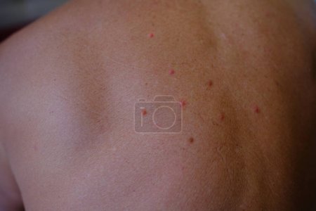 Juckreiz auf der Haut, verletzter männlicher Rücken aus nächster Nähe, von Mücken gestochene Haut, beschädigte gerötete Haut, Mittel gegen Insektenstiche, Kratzgefühl, Hautbeschwerden, Bissspuren