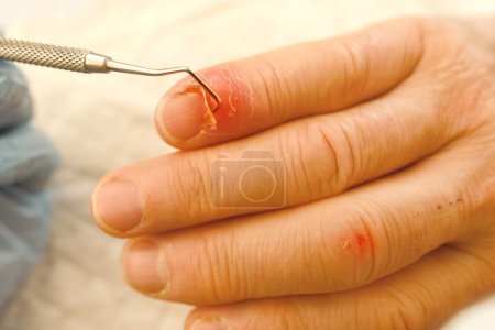 Arzt behandelt verletzte Finger, Nagelschäden durch Aufprall, Kompression, Riss, einen Teil der Verletzung des männlichen Daumens Nahaufnahme, Prellungen, industrielle oder häusliche Verletzungen, Rötungen, Eiterbildung