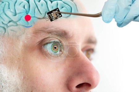 Instalación de chip electrónico en el cerebro humano, aplicado en diversos campos de la neurotecnología y la ciencia médica, tecnología de vanguardia, restaurar la vista