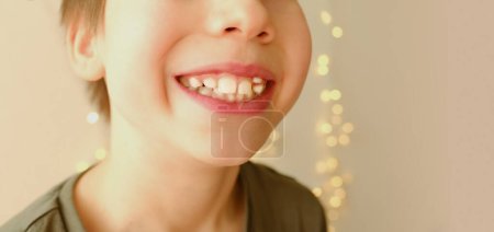 closeup crooked teeth, boy 9-10 years opened mouth, child 8 years old shows teeth, visit to dentist for examination oral cavity, control of molars, temporary teeth, concept of caries prevention