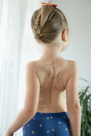 Rücken kleines Mädchen, Kind 5 Jahre alt wunde Stelle, gekrümmte Wirbelsäule, Schmerzen in der Wirbelsäule, therapeutische Massage bei Osteochondrose, Skoliose bei Kindern, Bandscheibenvorfall