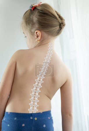 Rücken kleines Mädchen mit Skoliose, Kind 5 Jahre alt schief stehend, Wirbelsäulendeformität gekrümmt, orthopädischer Zustand, ärztlicher Behandlung bedürfen