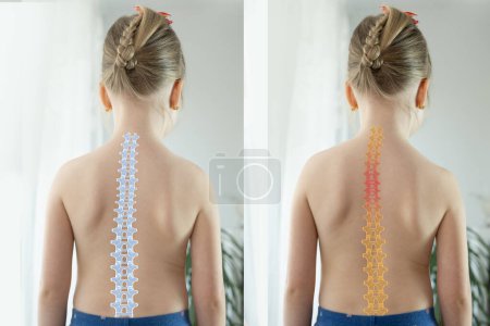 niño, niña que muestra columna vertebral sana normal y columna vertebral curvada con escoliosis, necesita atención médica, salud espinal, columna vertebral anormal