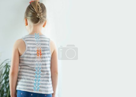 Rücken kleines Mädchen mit Skoliose, Kind 5 Jahre alt schief stehend, Wirbelsäulendeformität gekrümmt, orthopädischer Zustand, ärztlicher Behandlung bedürfen